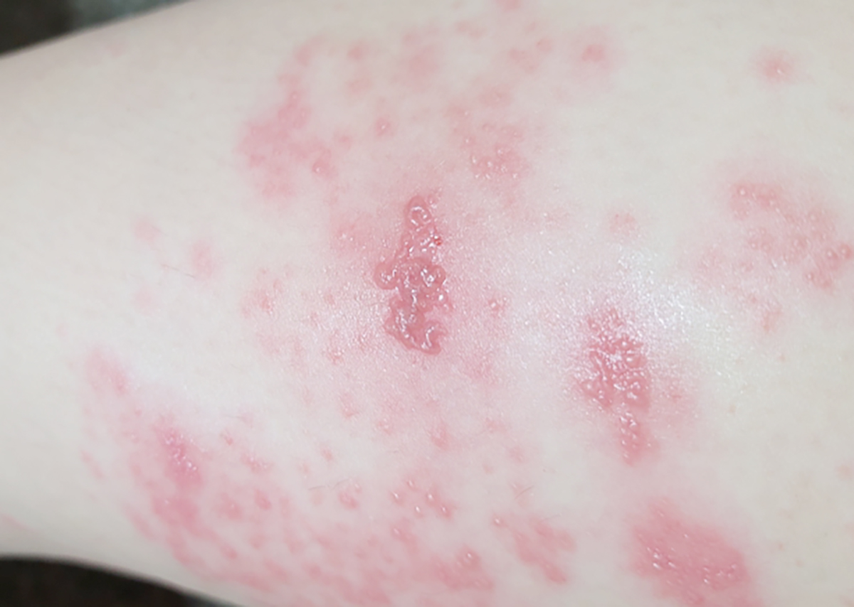 수두의-수포-모습