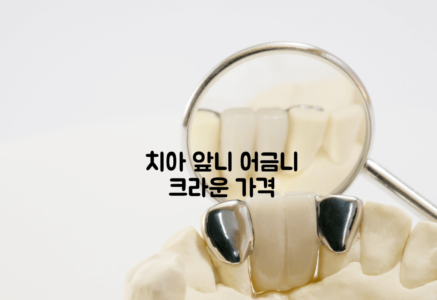 치아 크라운 가격
