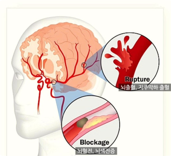뇌동맥류와 지주막하출혈의 위험성 관련 이미지