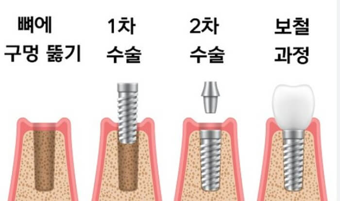 임플란트 과정을 4단계로 설명한 사진