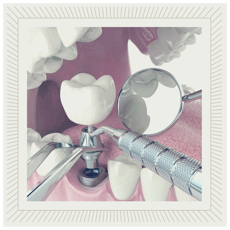 치과 임플란트 건강보험적용가격