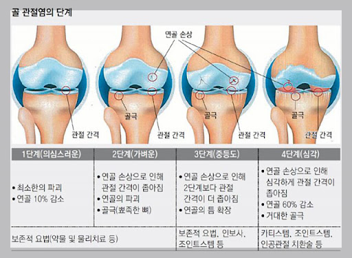 관절손상(출처 바이오스타)