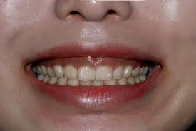 잇몸이 붓고 아플 때