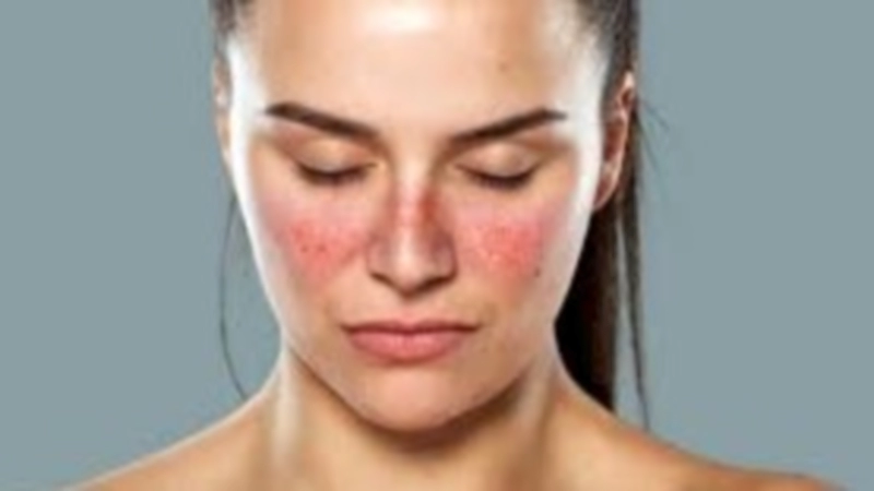 루푸스 증상 진단 검사 치료