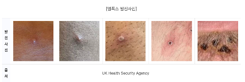 엠폭스 발진사진