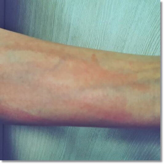 자가면역질환 두드러기가 심한 여성