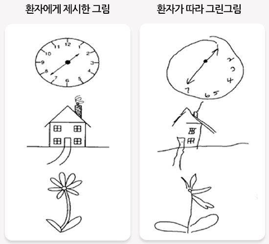 우반구-뇌졸중-환자에서-나타나는-좌측-무시현상