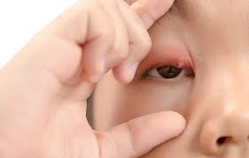 눈다래기 빨리 낫는 법