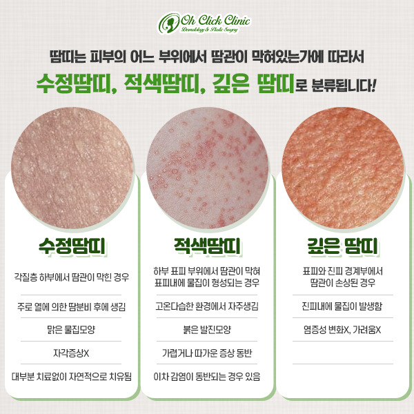땀띠의 종류
