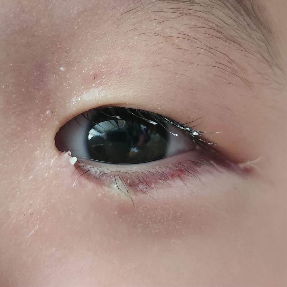 수술 2일 후 눈