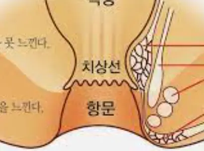 치질-증상-자가치료법-건강
