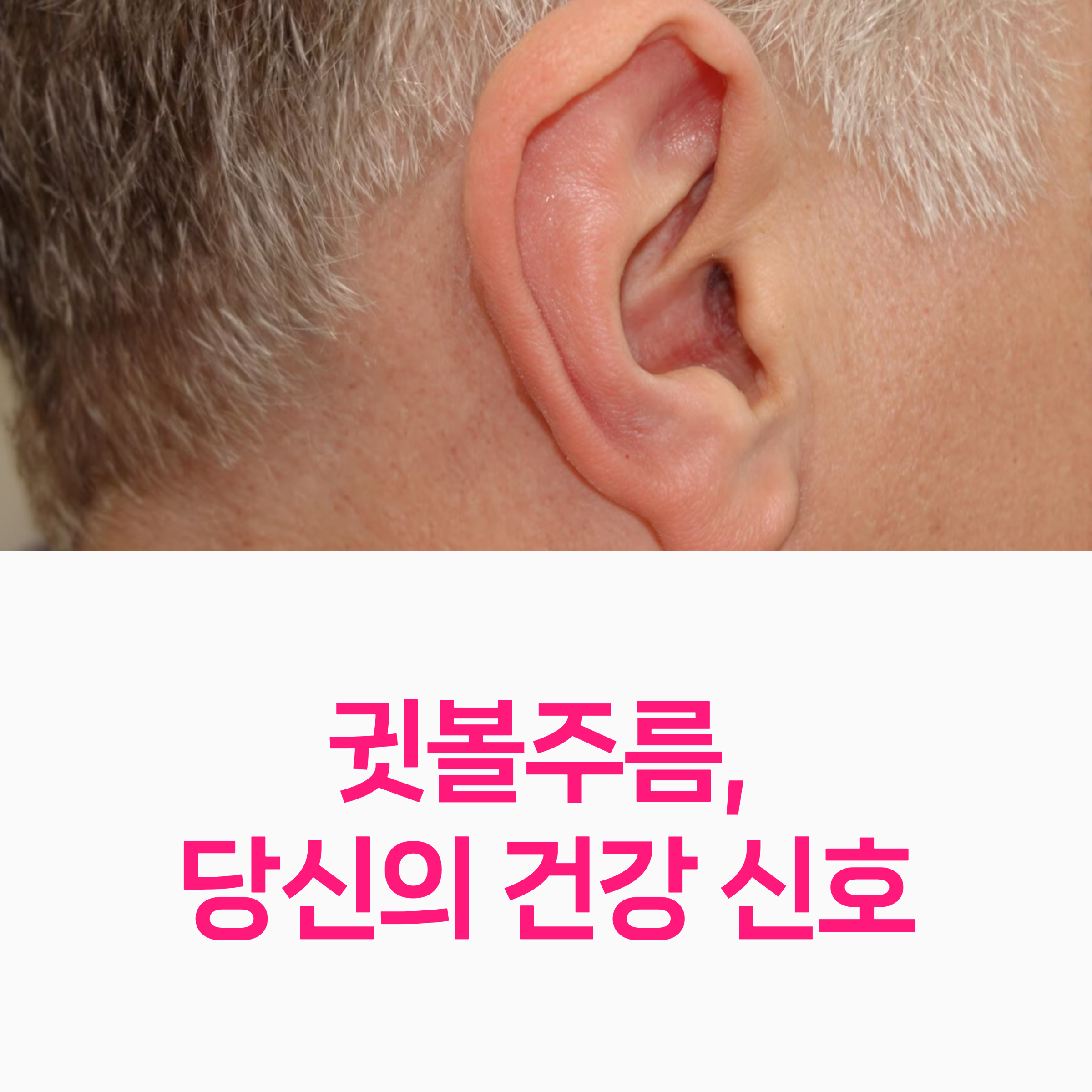 귓볼주름