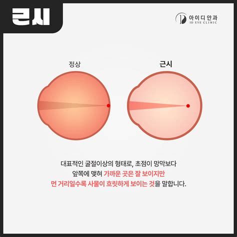 난시 라식