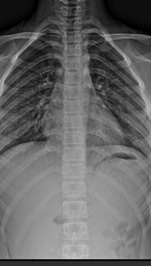 흉추 전후면, 측면 사진