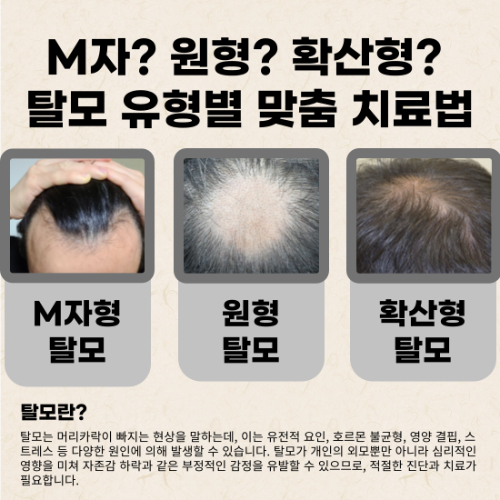 탈모란