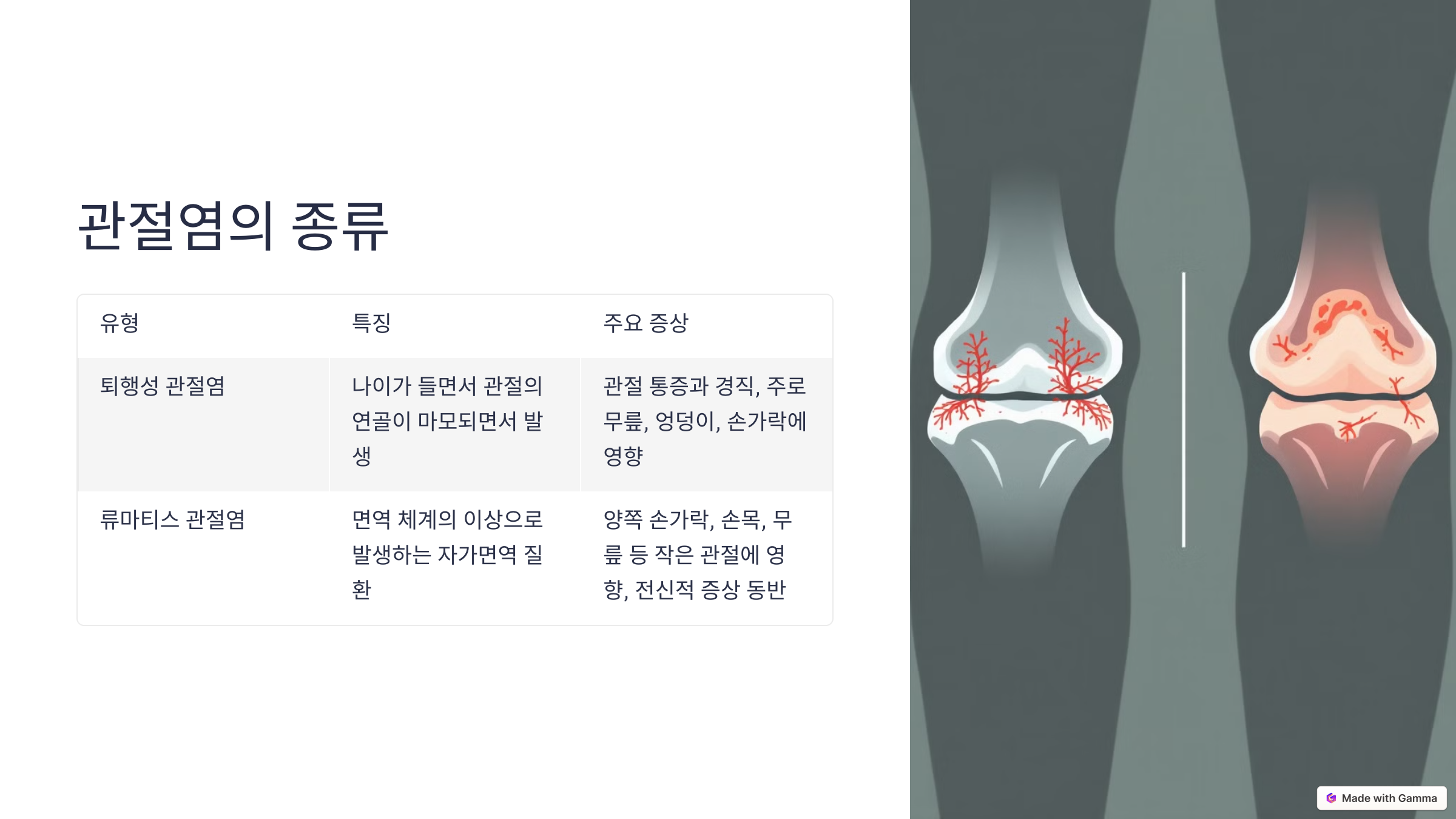 퇴행성 관절염과 류마티스 관절염