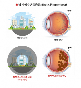 망막변성