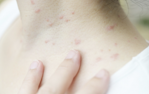 건선의 종류와 증상