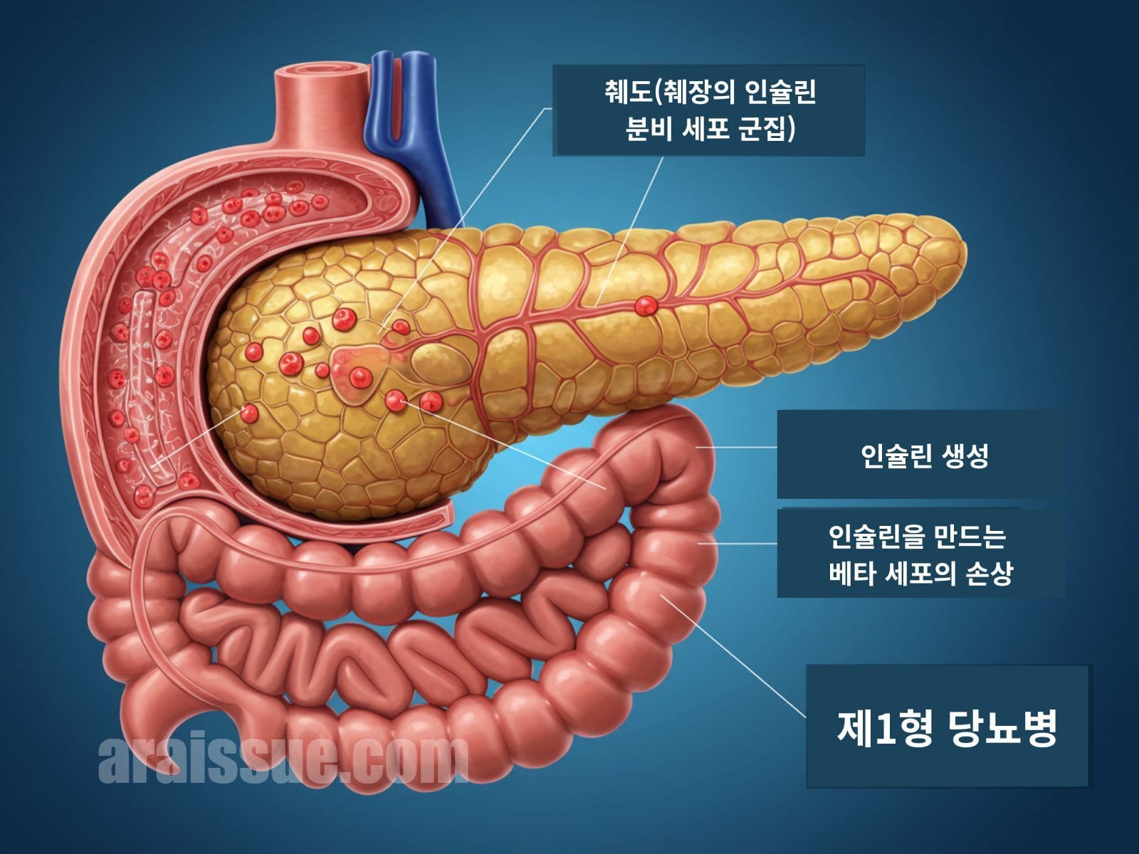 췌도 기능과 인슐린 분비 구조 설명 이미지