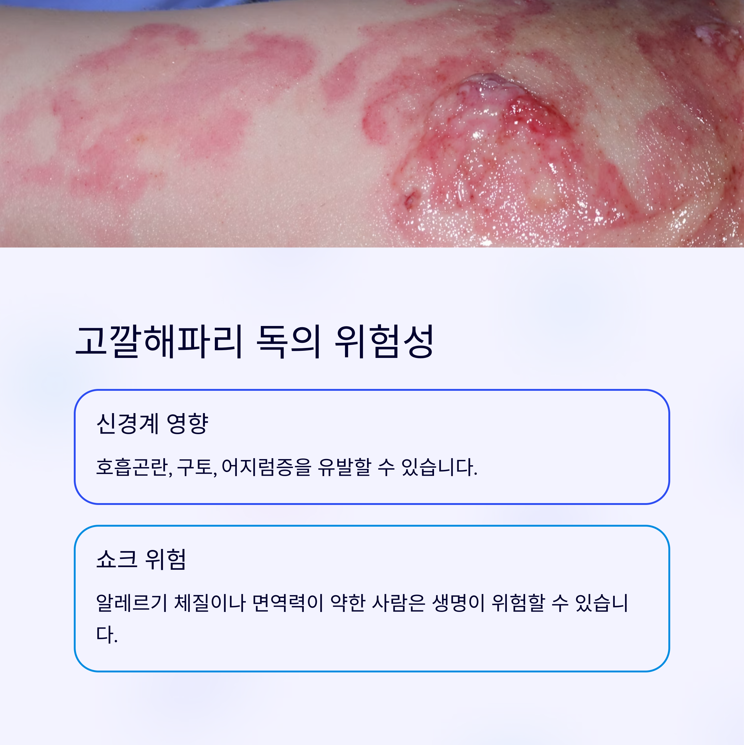 고깔해파리 쏘이면 생기는 증상