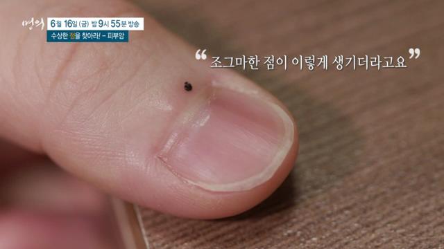 명의 수상한 '점'을 찾아라, 피부암, 악성 흑색종, 예방, 치료 방법
