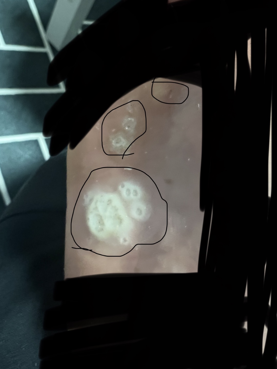 사마귀 퍼지는중