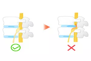 허리디스크 치료법