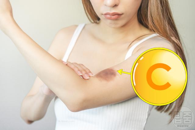 필수 비타민 부족 결핍 증상 멍