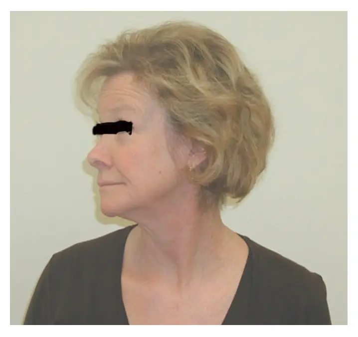 소흉근 증후군: 정확한 진단법과 효과적인 치료 운동법