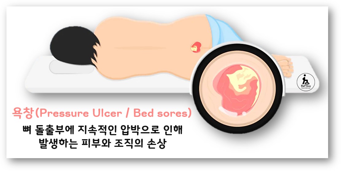 욕창(Pressure Ulcer 또는 Bed sores)