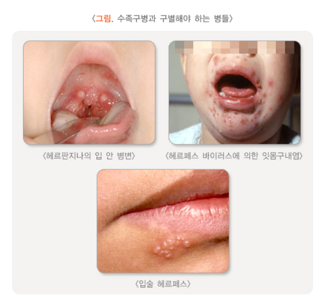 수족구와 구별해야 하는 질병들