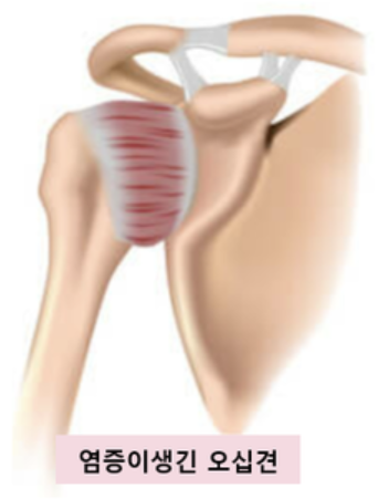 오십견 증상 1