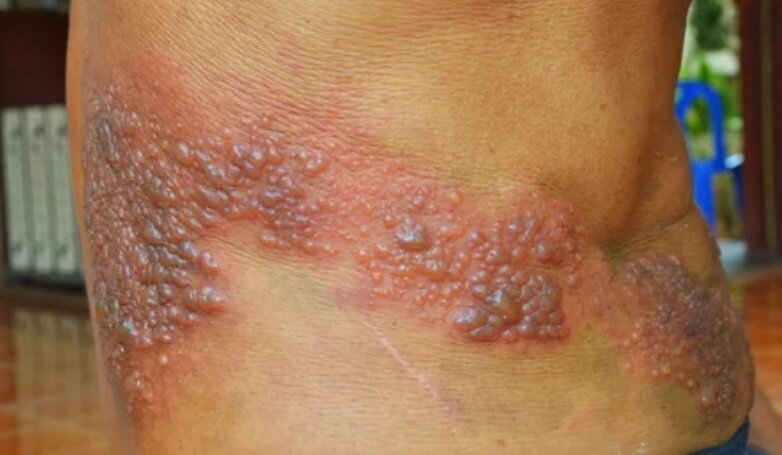 대상포진 초기증상 대상포진 조기치료 대상포진 초기증상 및 조기치료