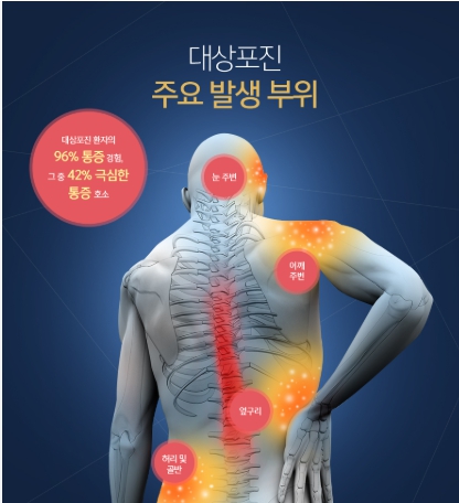대상포진 초기 증상 후유증