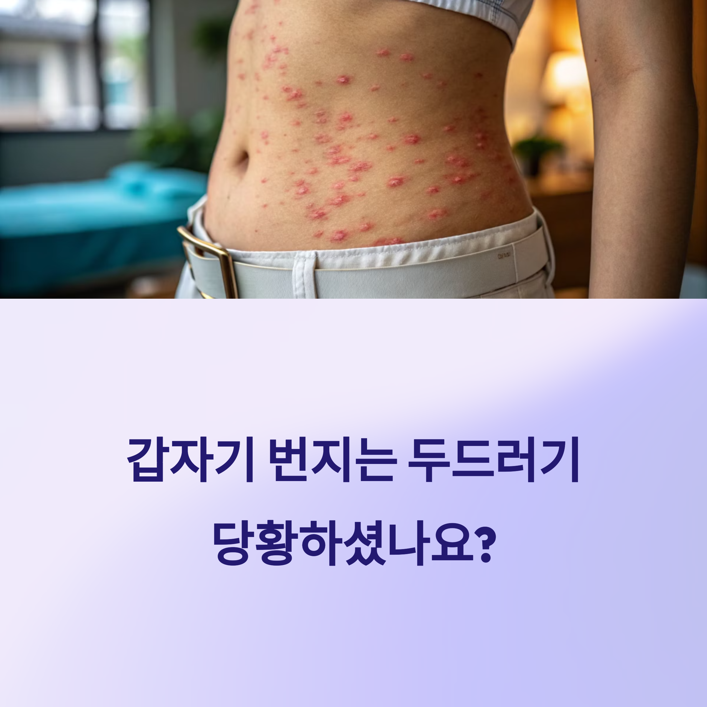 두드러기 원인 모를 때 대처법!
