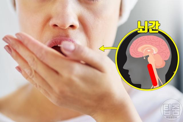 여자 뇌졸중 증상 특징 딸꾹질