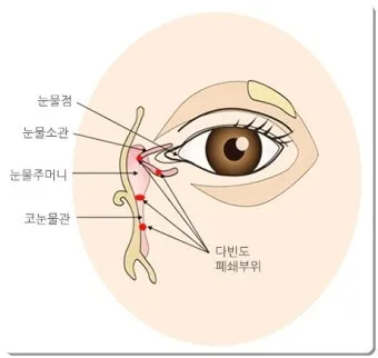 눈물이 자주 나는 이유에 대한 안과정보_13
