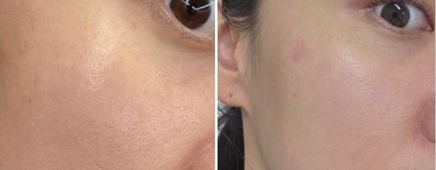 불뉴머 피부변화