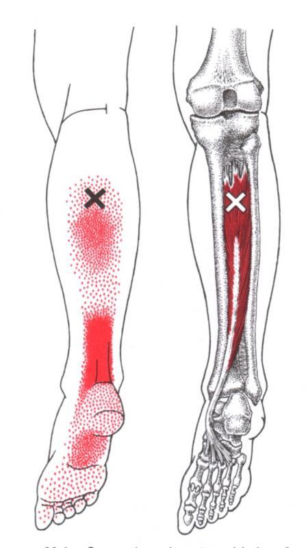 후경골근 (Tibialis posterior) 통증 유발점 위치