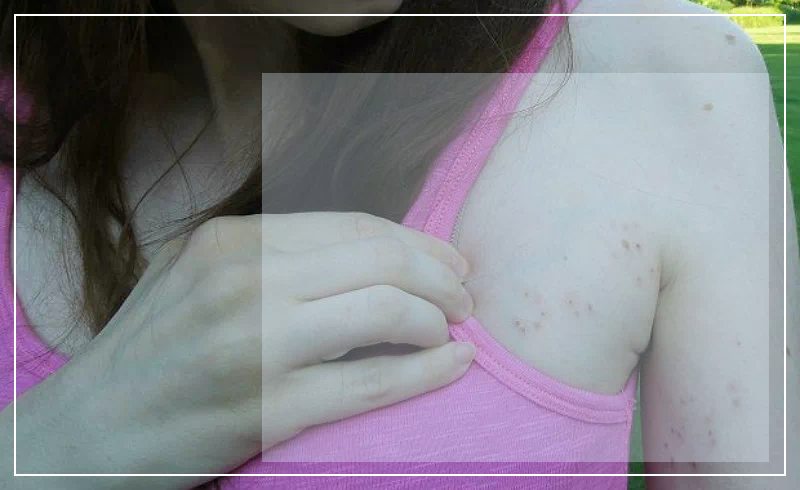 겨드랑이 대상포진