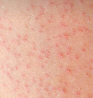 디페린-겔-크림-사용법-효과