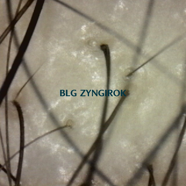 탈모 극복 프로젝트 - 탈모약 복용 33주차 정수리와 이마 사이 두피모습이다.