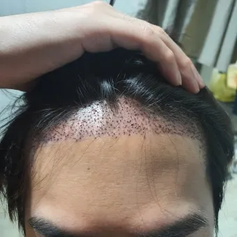 머리카락 이식 3000모 3000모낭 비용과 시술 과정_7