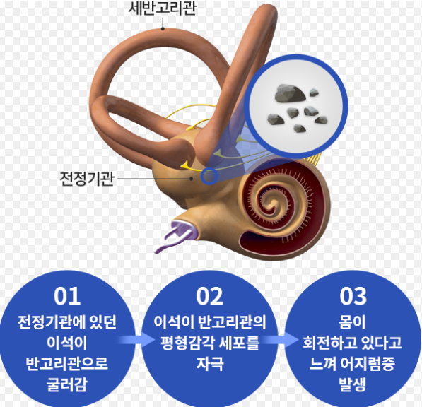 이석증 증상과 자가치료법