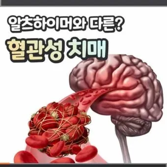 혈관성치매 원인 증상 치료법과 예방 생활습관_20