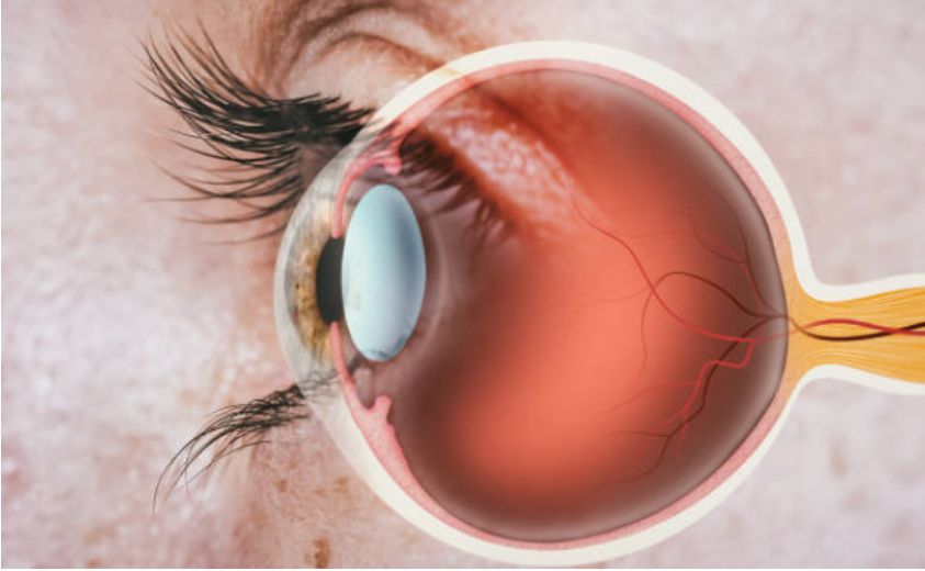 비문증의 원인, 증상, 치료방법
