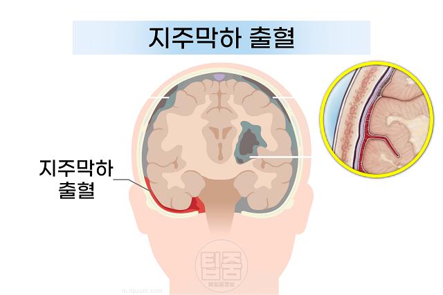 뇌혈관 터짐 위치 뇌출혈 종류 지주막하출혈