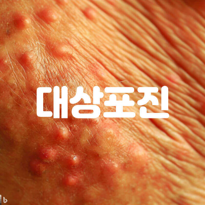 대상포진
