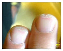 손톱이 갈라지는 이유 원인 증상 대처법_7