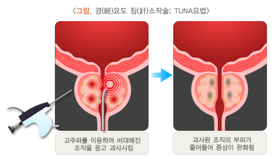 경요도침소작술